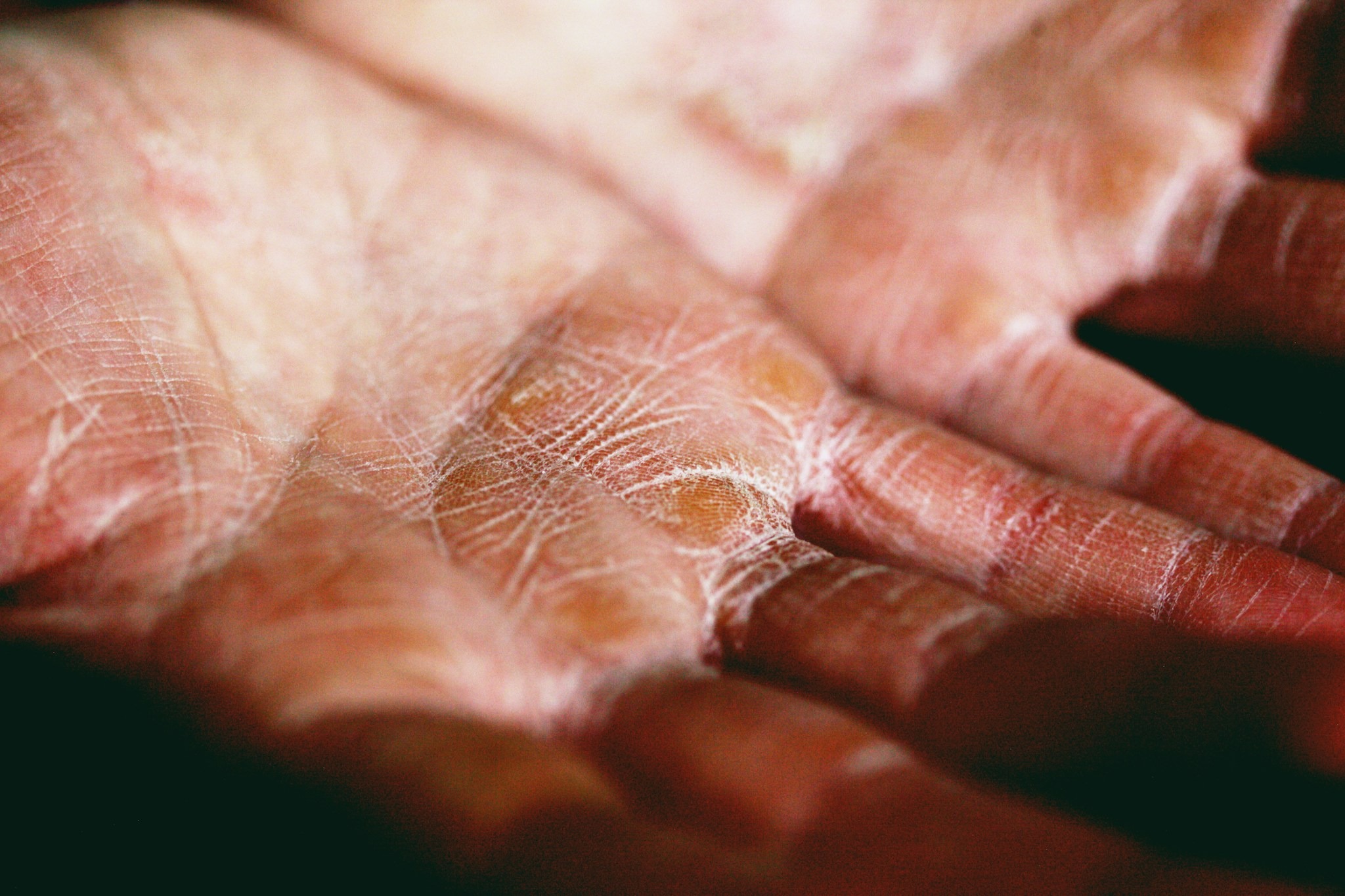 Teen Eczema - A Parent's Guide