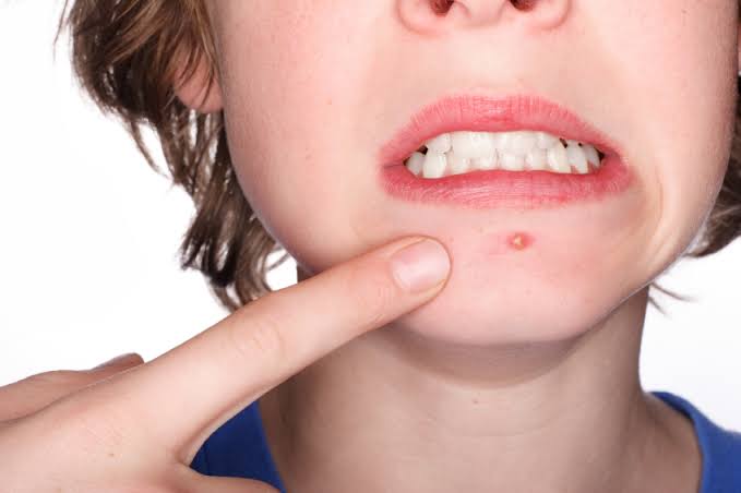 Pro-active Acne Care